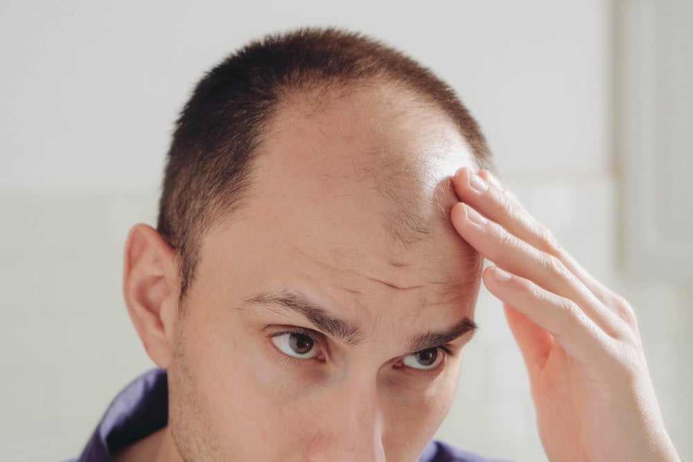 Tipos de alopecia: causas y tratamientos